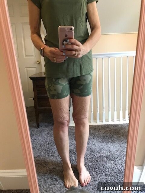 Loose skin on legs after 100 pounds lost